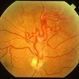 Wyburn Mason Syndrome Wyburn Mason Syndrome